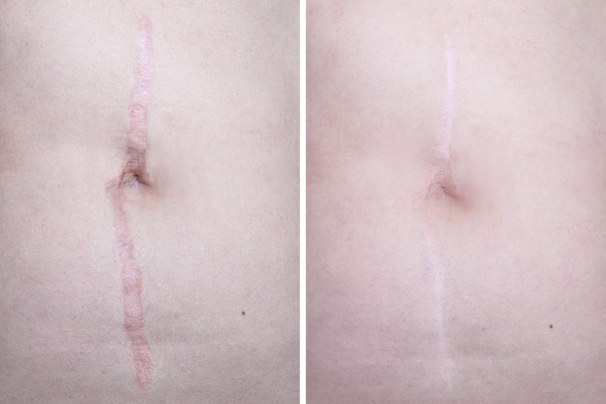 Abdomen scar before and after camouflage tattooing