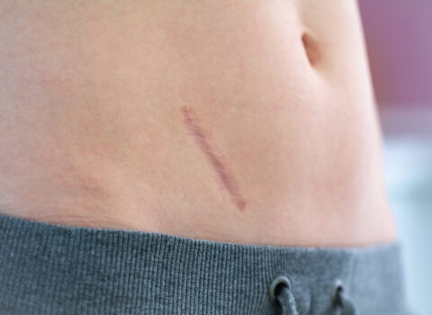 Diagonal scar on the lower back, skin tone with a gray hoodie edge at the bottom edge of frame