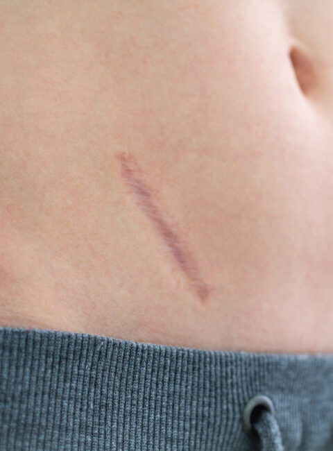 Diagonal scar on the lower back, skin tone with a gray hoodie edge at the bottom edge of frame