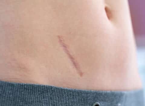 Diagonal scar on the lower back, skin tone with a gray hoodie edge at the bottom edge of frame