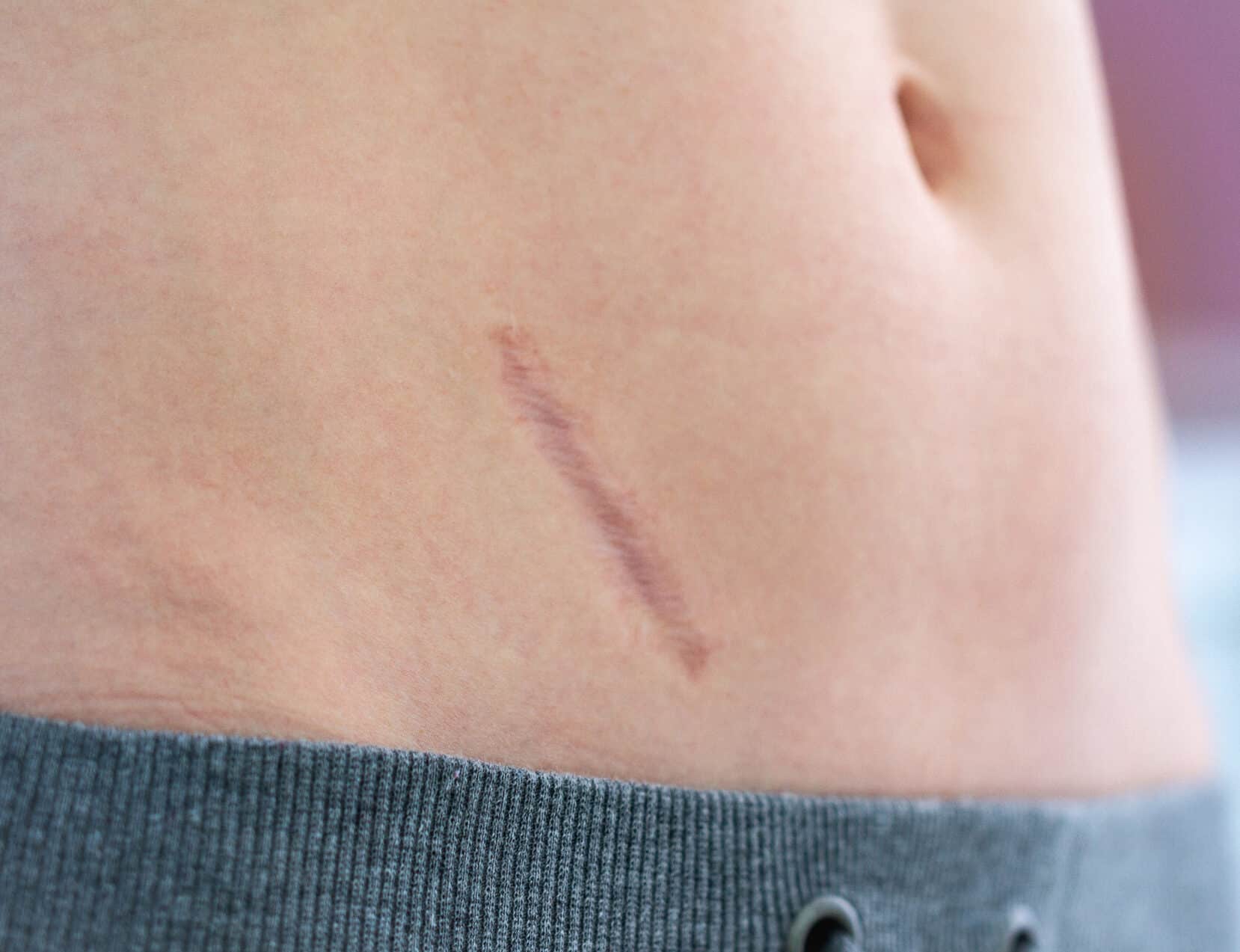 Diagonal scar on the lower back, skin tone with a gray hoodie edge at the bottom edge of frame