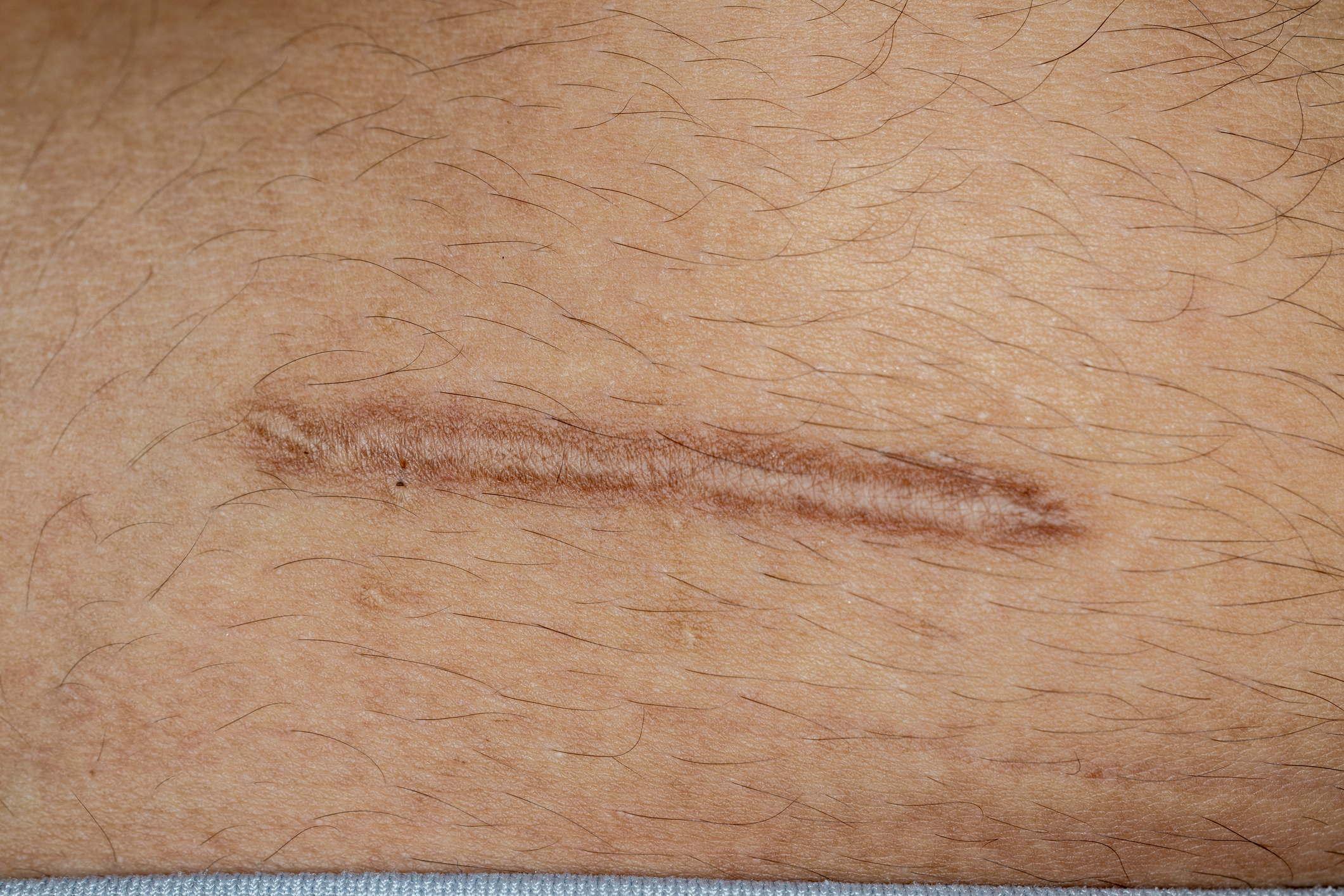 Bi-tone scar camouflage transformation