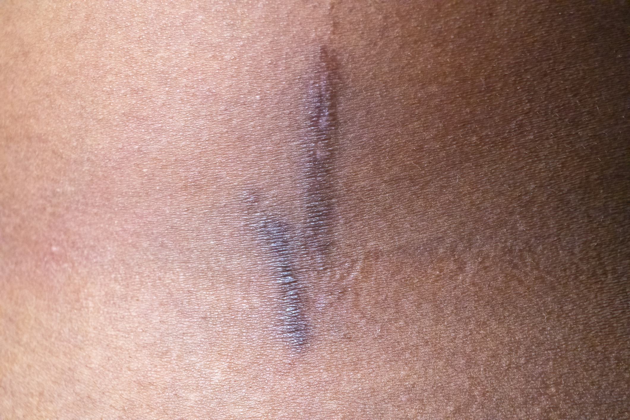 Dark back scar camouflage candidate